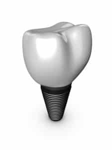 a brief history of dental implants