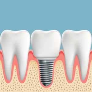 did you know a dental crown can replace a lost tooth