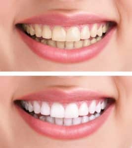 whiter teeth