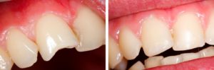 composite-bonding