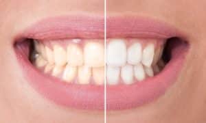 whitening2