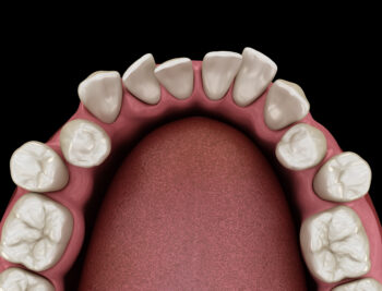 Browne shifting teeth