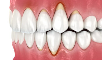 Robert Brown Gum Disease