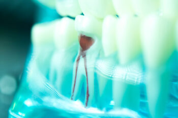 Browne Root canals