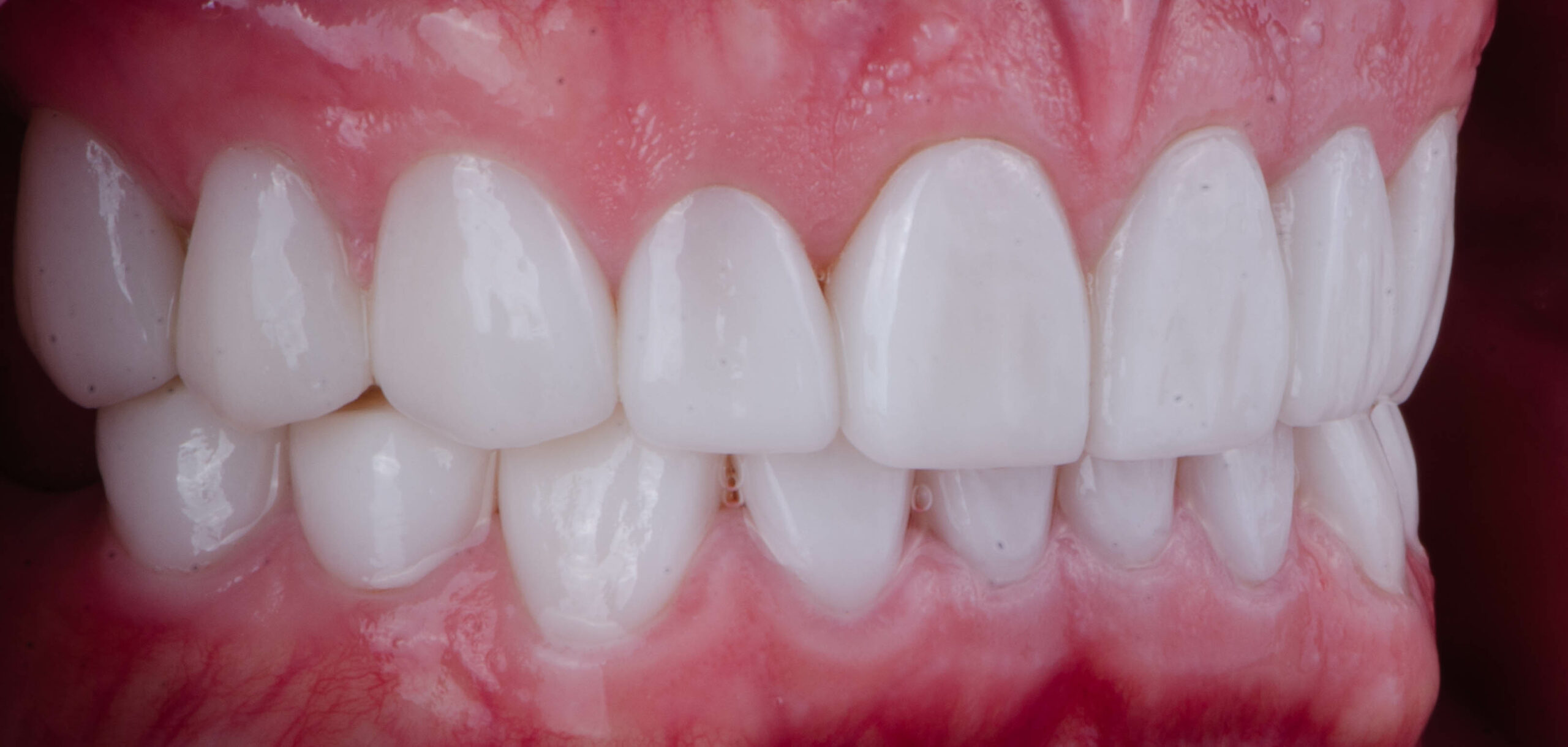 Ultrasonic Scaling Helps You Manage Gum Disease