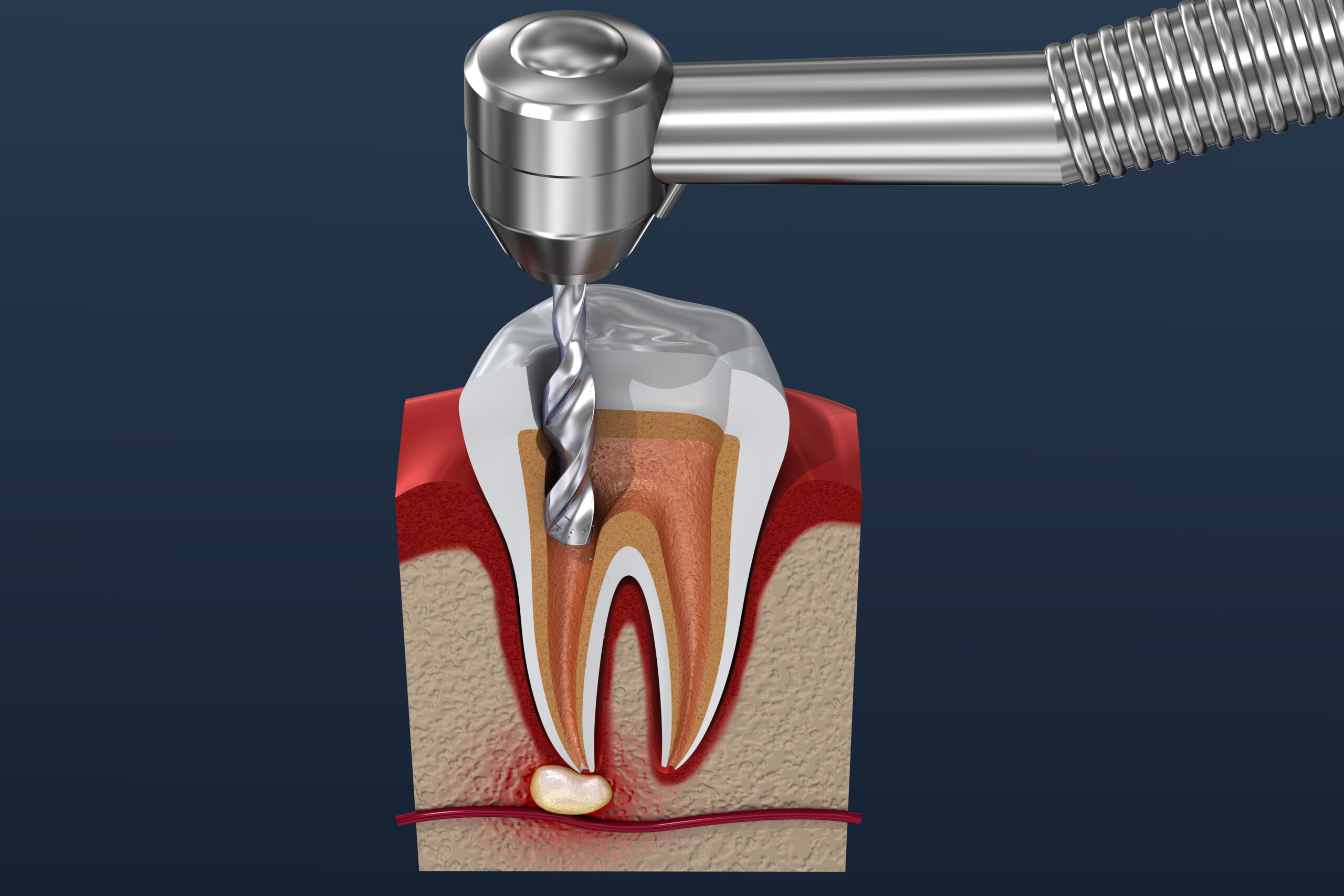 Treating An Infected Tooth With A Root Canal | Prairie Village, KS