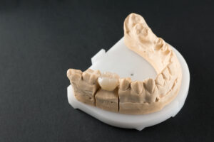 prairie village dental crown