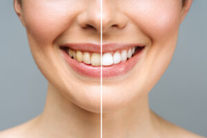 prairie village teeth whitening