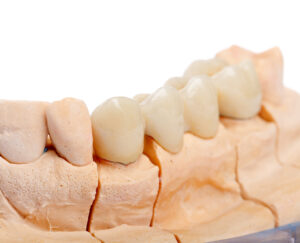 prairie village dental bridge