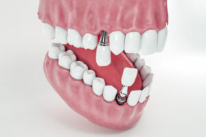 prairie village dental implants