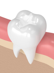 prairie village dental filling