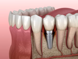 prairie village dental implants
