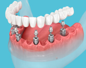 prairie village implant dentures