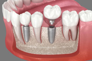 prairie village dental implants