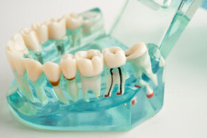 prairie village root canal