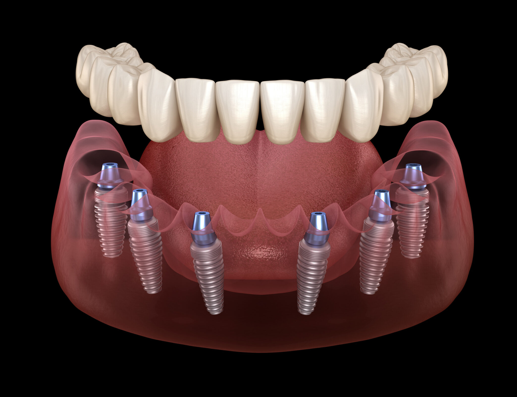 Supporting A Prosthetic With Implants | Prairie Village, KS