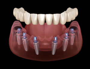 prairie village dental implant denture