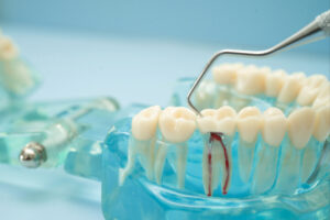 prairie village root canal