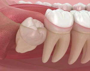 prairie village tooth extractions