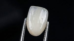 prairie village veneers