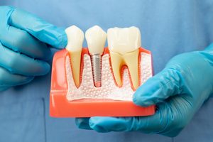 prairie village dental implants