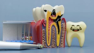 prairie village root canal